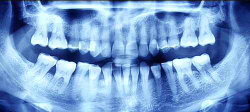 Dental X-Ray Dental X-Ray