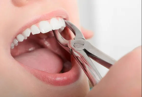 Wisdom Tooth or Tooth Extraction