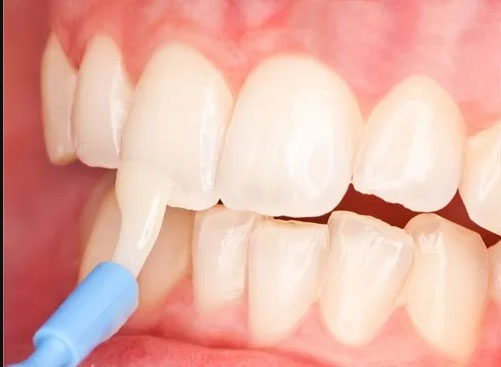 Fissure Sealant
